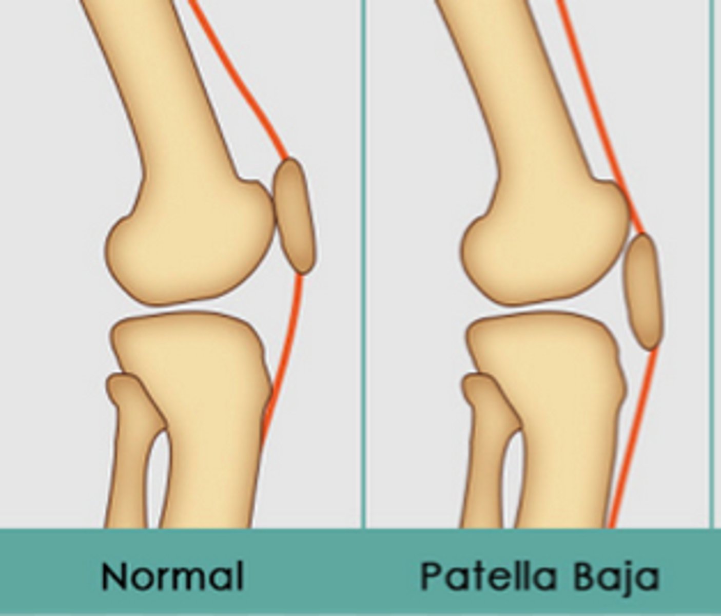<p>low riding patella</p>