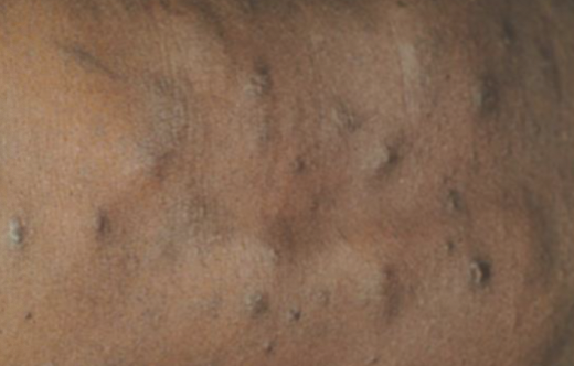 <p>large, solid elevated lesion</p>