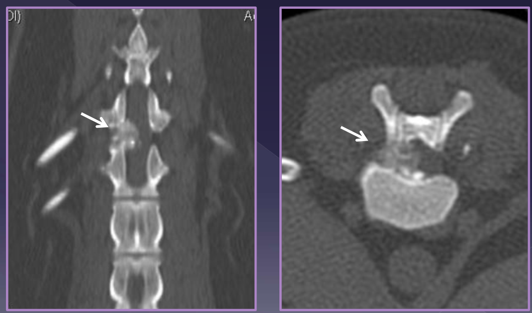 <ul><li><p>chondroid metaplasia </p><ul><li><p>loss of water content </p></li><li><p>deposition of mineral </p></li><li><p>alteration of proteoglycans </p><ul><li><p>equals intradiskal pressure </p></li></ul></li></ul></li><li><p>signalment </p><ul><li><p>chondrodystrophic breeds </p></li><li><p>dachshund - 10x increased risk </p></li><li><p>3-5yr (TL), 8-12yr (cervical) </p></li></ul></li><li><p>clinical presentation </p><ul><li><p>compressive myelopathy </p></li><li><p>contusion injury </p></li></ul></li><li><p>acute, progressive </p></li><li><p>severity may depend on factors: </p><ul><li><p>location of compression </p></li><li><p>duration of compression </p></li><li><p>velocity / force of herniation </p></li><li><p>volume of disc herniation </p></li></ul></li></ul><p></p>