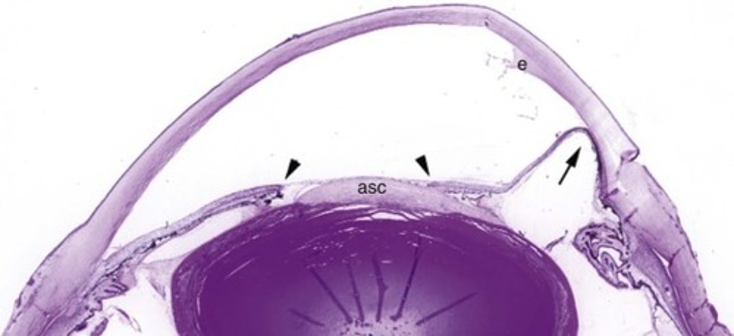 <p>Information for Condition:</p><p>Inflammation causing synechia (adhesion) of iris to back of cornea; Often associated with vision loss</p>