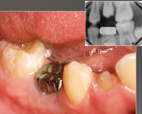 <ul><li><p class=""><strong>Cessation of eruption</strong>&nbsp;after the tooth emerges.</p></li><li><p class=""><strong>Fusion of cementum with bone</strong>.</p></li><li><p class=""><strong>Unknown pathogenesis</strong>&nbsp;(cause not fully understood)</p></li></ul><p></p>