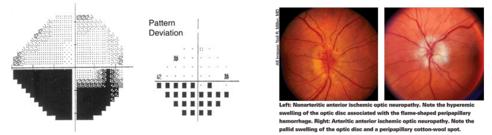 <p><strong>Occlusion of the posterior ciliary arteries </strong>- not enough oxygen getting in</p><p><strong>Non-arteritic</strong> anterior ischemic optic neuropathy (NAION) - associated with vascular disease and sleep apnea</p><p><strong>Arteritic </strong>anterior ischemic optic neuropathy (AAION) - ocular emergency/ from GCA</p><p>Altitudinal defects; not distinct or flat edges → nerve swelling</p>