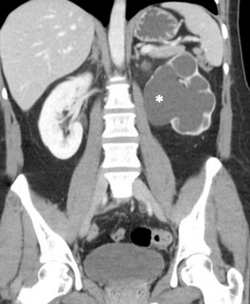 <p>What pathology is indicated at the asterisk?</p>