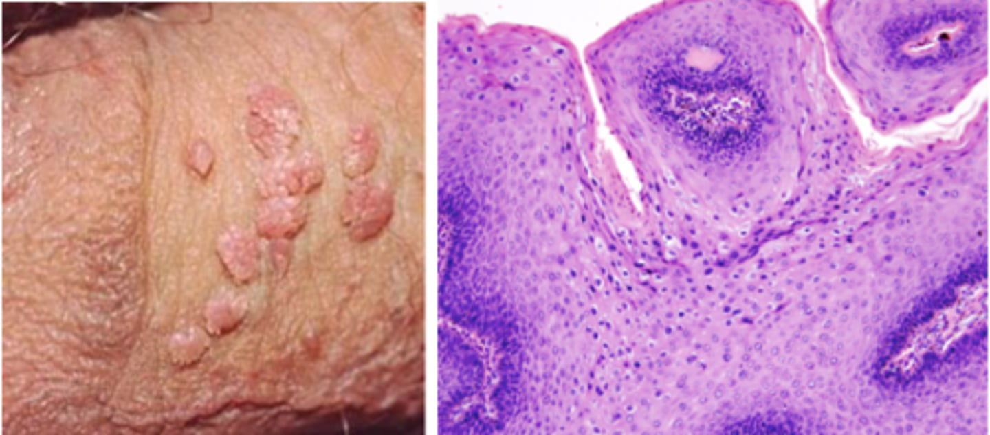 <p>painless, soft, moist; MOST COMMON, caused by early onset, use of contraceptives, multiple partners; cause bed HPV, high risk for cervical cancer in women = Gardasil series of 3 shots for 9-26 years old in boys</p>