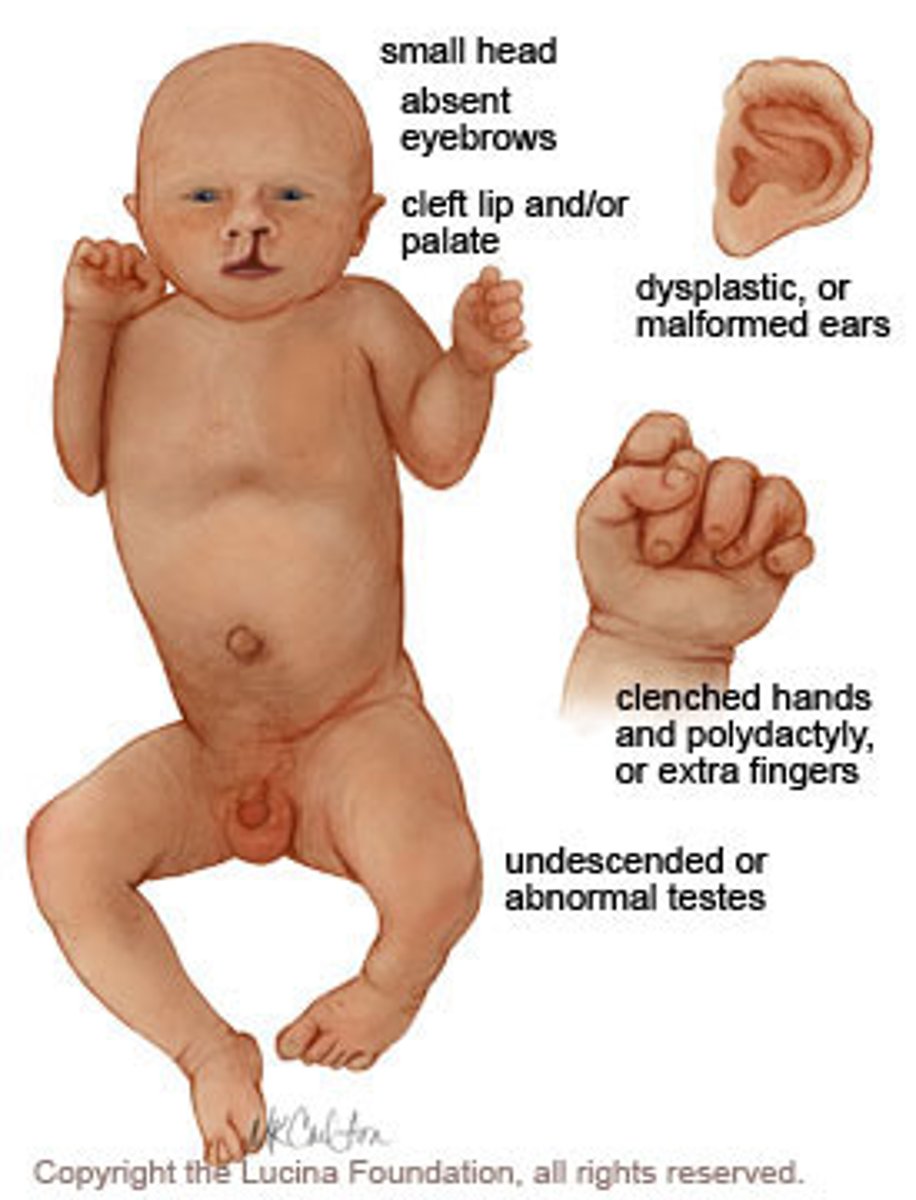 <p>trisomy 13 (Patau's)</p>