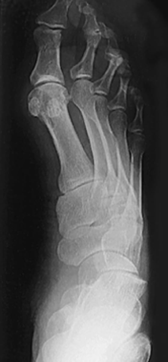 <p>- 30° lateral rotation</p><p>- CR to base of third MT</p><p>- Demonstrates base of first MT and medial tarsals</p>