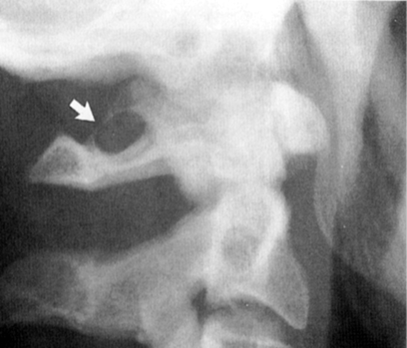 <p>Calcification of the inferior/oblique aspect of the atlanto-occipital ligament/membrane</p>
