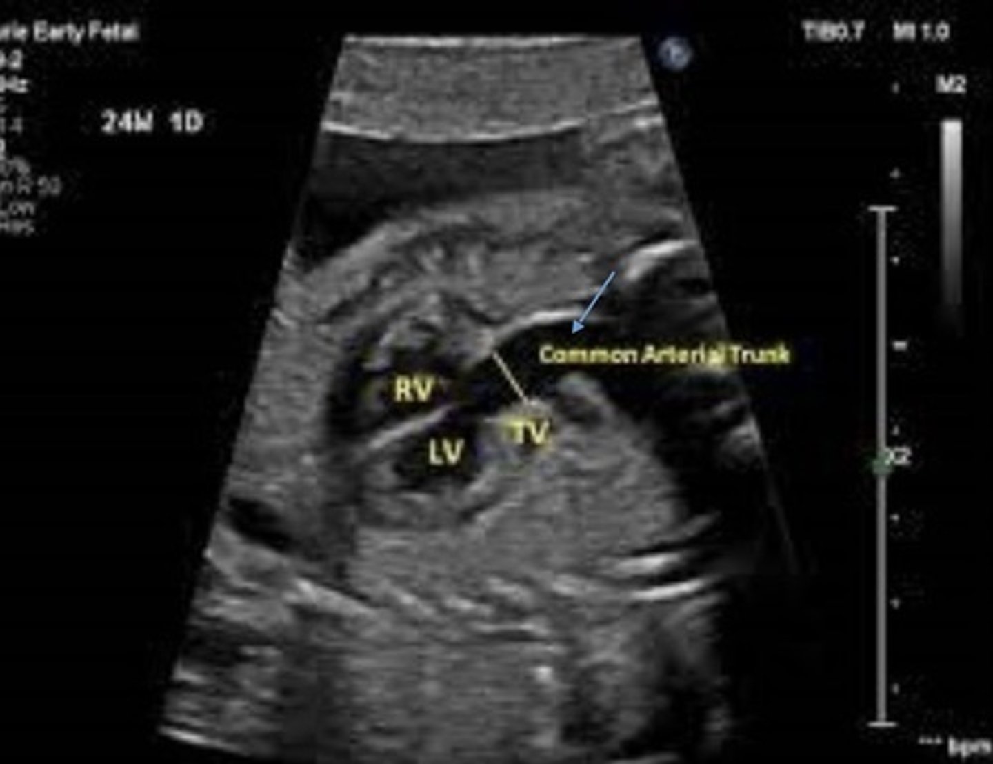 <p>Best seen in LVOT view</p><p>Truncoconal ridge fails to fuse</p><p>Appears as single great vessel with VSD</p>