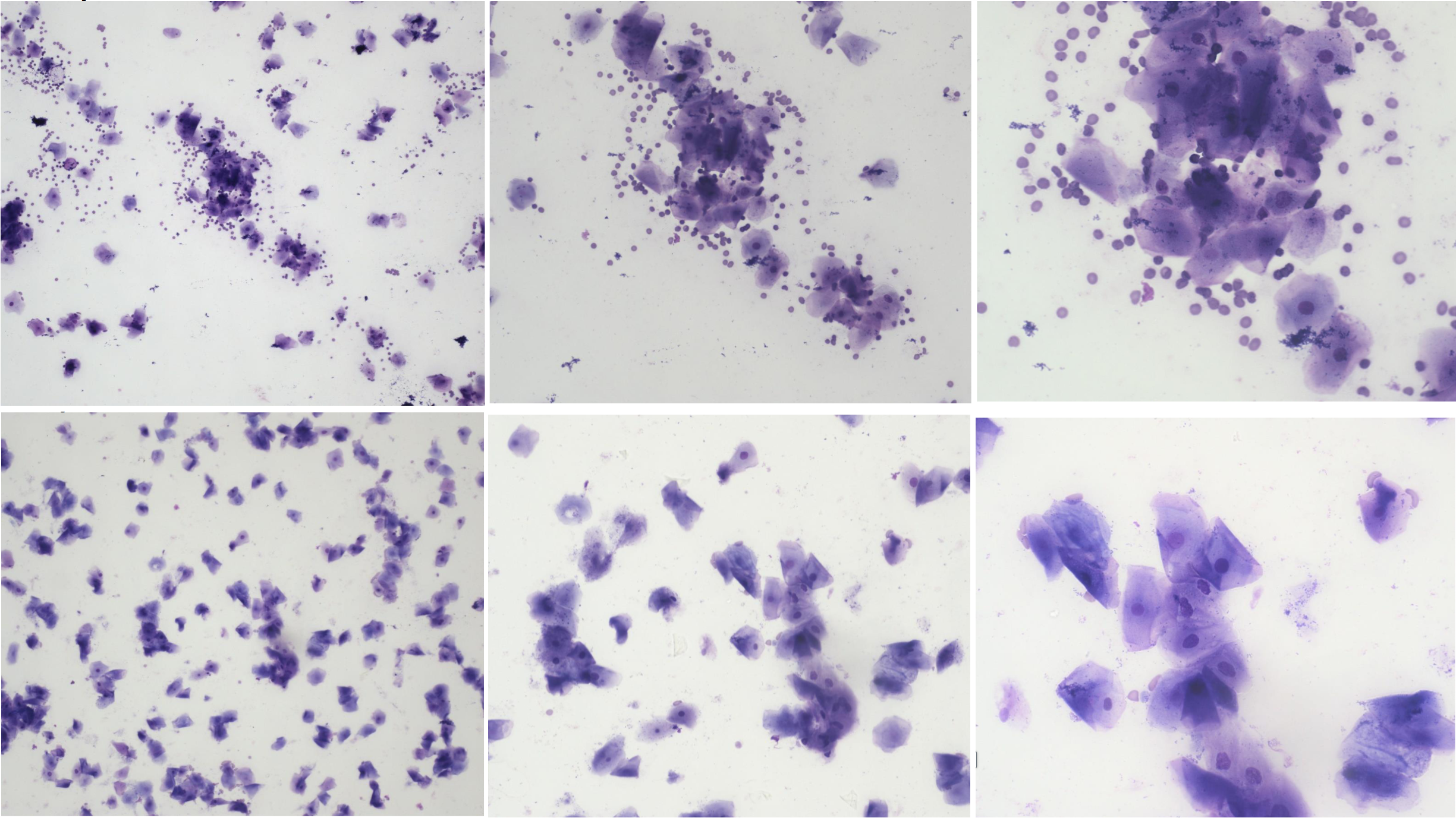 <p>Utstryk 8<br>Parabasalceller: <br>Intermediärceller: <br>Superficialceller:<br>Erytrocyter:<br>Neutrofiler:</p><p>Stadium:</p>