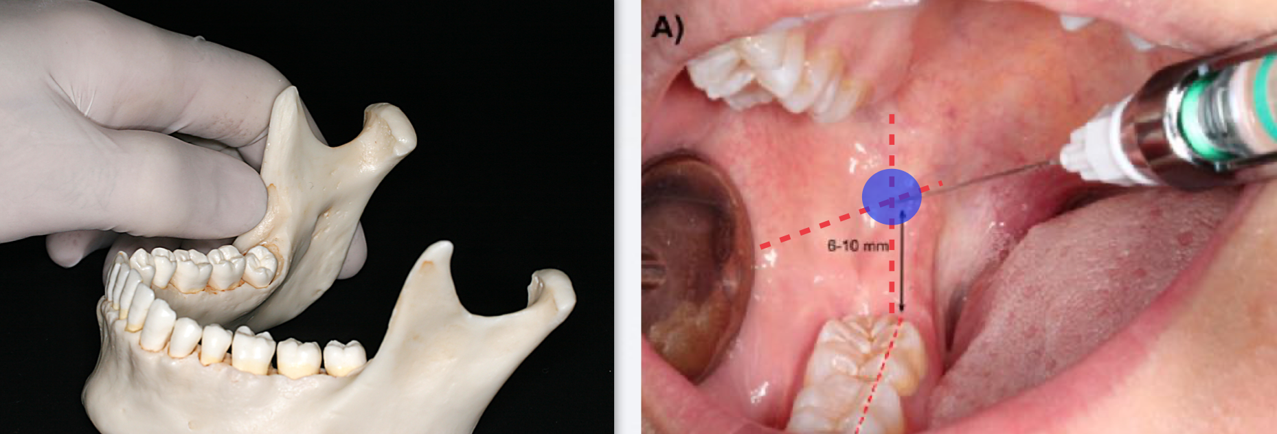 <ul><li><p>Place thumb at the coronoid notch, parallel to the plane of occlusion</p></li><li><p> The imaginary line begin at the midpoint of the notch and terminate at the deepest part of the pterygomandibular raphe</p></li><li><p>Place finger in the coronoid notch (greatest concavity on anterior border of the ramus)</p></li><li><p>Continue the imaginary line to the deepest part of the pterygomandibular raphe. (In most patients, this line lies 6-10 mm above the mandibular occlusal plane)</p></li><li><p>Needle insertion lies 3/4th of the anteroposterior distance of this line</p></li></ul><p></p>