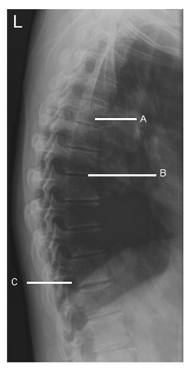 <p>intervertebral disk</p><p>3 multiple choice options</p>