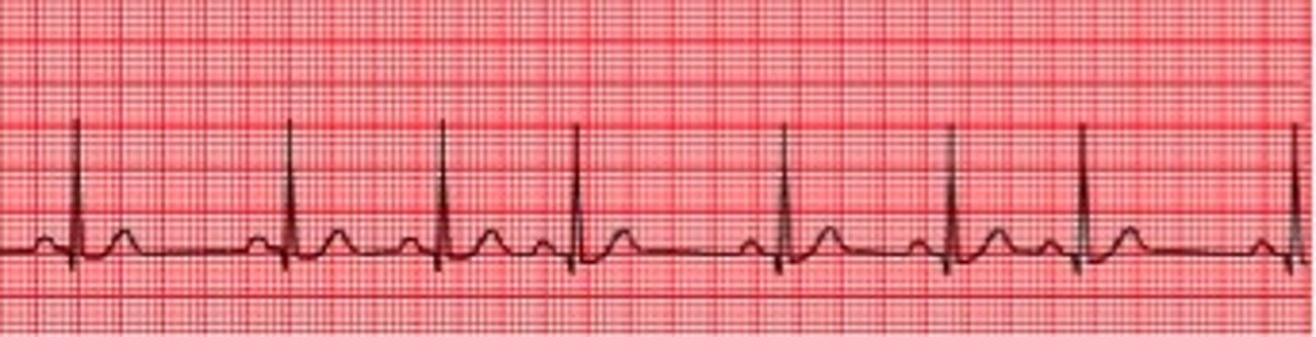 <p>irregular heartbeat</p>