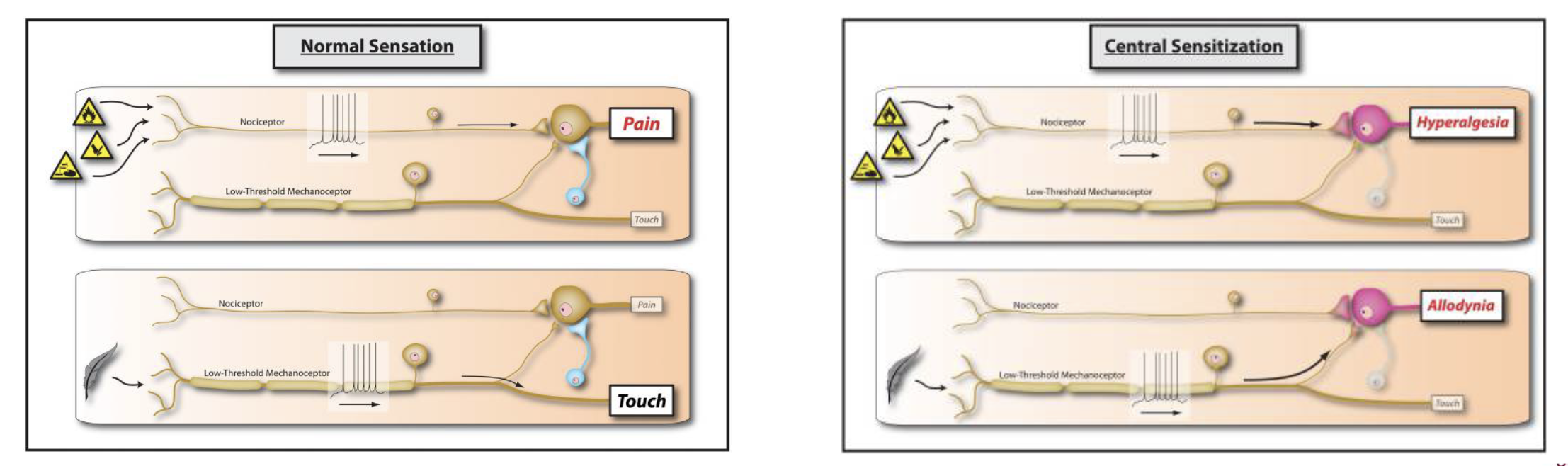 Amplification of neural signalling (e.g. nociceptive info) within the CNS that elicits pain hypersensitivity or even normal stimuli (allodyina)

\
**using pathways over and over causes them to become hypersensitive (chronic injuries/pain)**