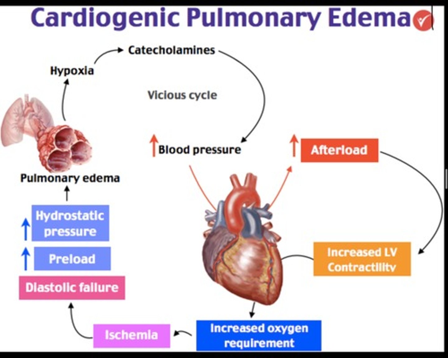 <p>Left-sided Heart Failure</p><p>- ↑ BP</p><p>- Rales</p><p>- JVD</p><p>- S3 gallop</p><p>- Back up of blood into the lungs</p>