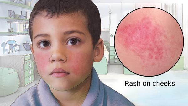 <p>What childhood disease does Parvovirus B19 cause?</p>