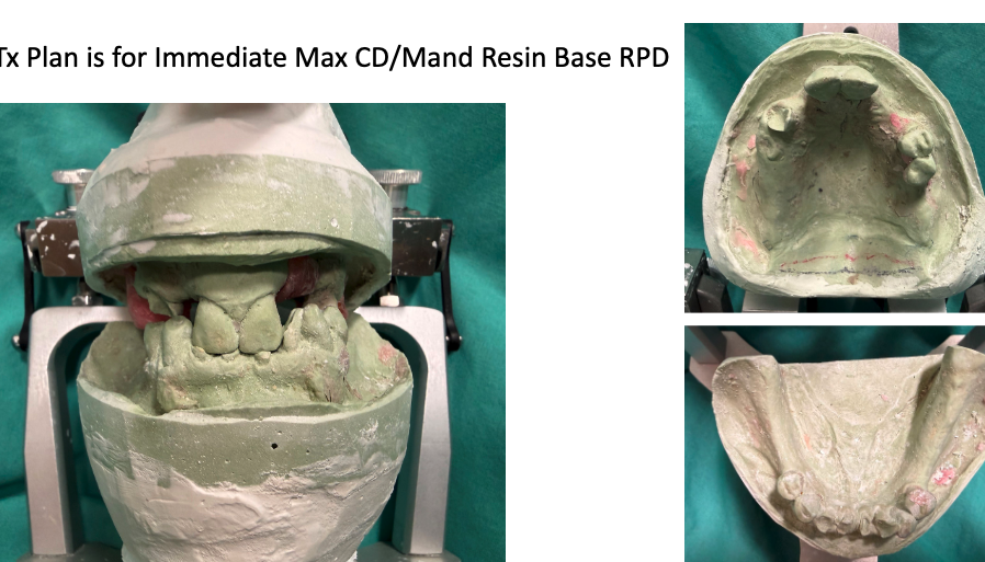 <p>did the student use the proper type of dental stones?</p>