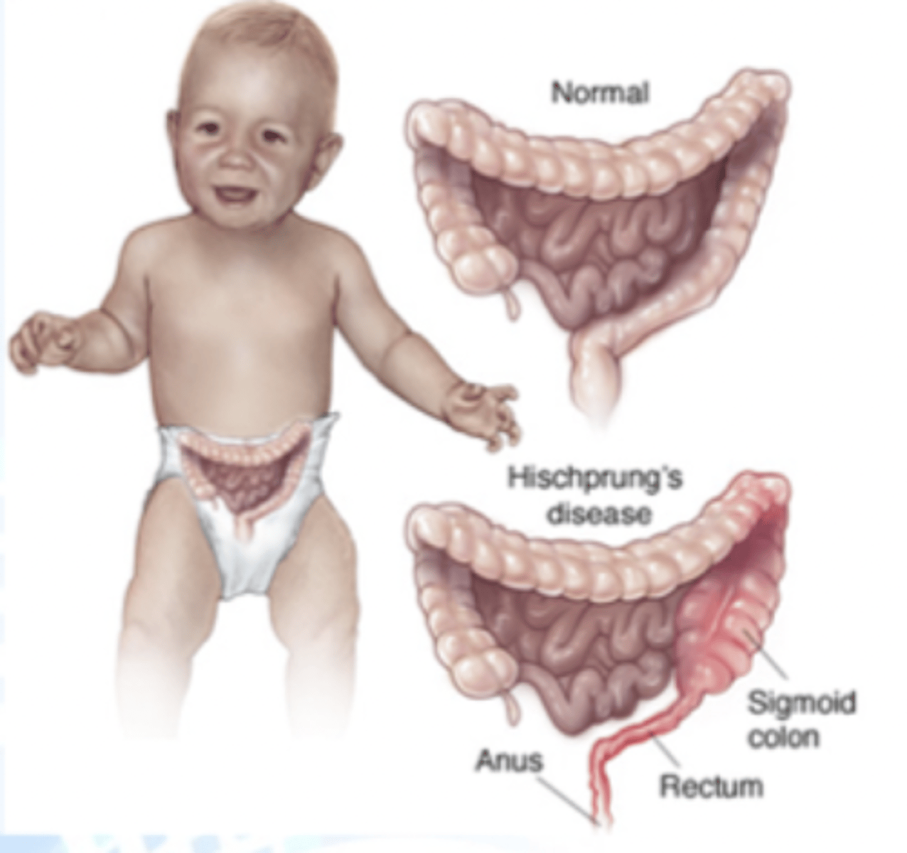 <p>condition of the large intestine (colon) that causes difficulty passing stool</p><p>- involves missing nerve cells in the muscles of part or all of the large intestine (aganglionic cells are unable to relax the smooth muscle)</p><p>- position is everything during a rectal exam!</p><p>- dx: through biopsy</p><p>- tx: cecostomy tube (chait tube)</p>