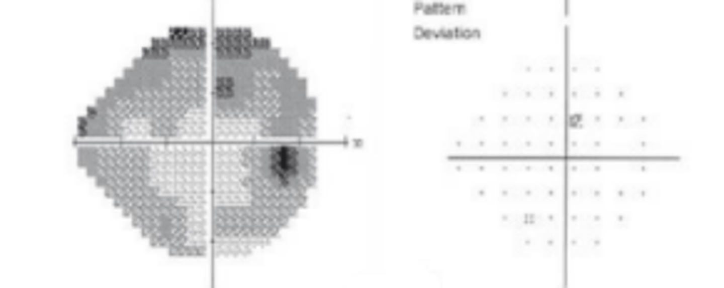 <p>function specific perimetry designed to assess blue cones and K cells which encode blue yellow opponency via a blue stimulus presented against a yellow background. Although glaucoma does not preferentially target these cells, targeting these specific RGC (9%) reduced redundancy of testing for earlier detection of glaucomatous defects. This test is more affected by cataracts so it is important to analyze pattern deviation results.</p>