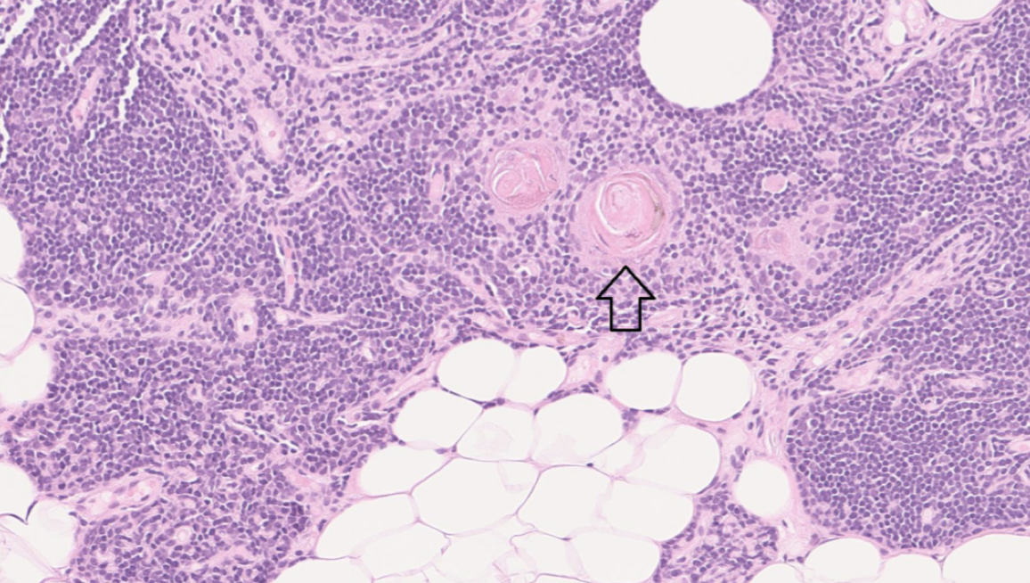 <p>Finns endast i thymus. Tätt packade epitelceller. På bilden syns även mycket fett. </p>