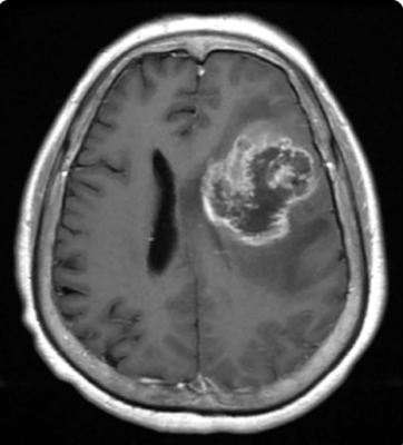 <ul><li><p>S/S: Chronic headaches, N/V, cognitive/personality/ visual changes, seizure</p></li><li><p>Dx: <strong>Biopsy</strong> + Head MRI with gadolinium </p></li></ul><p></p>