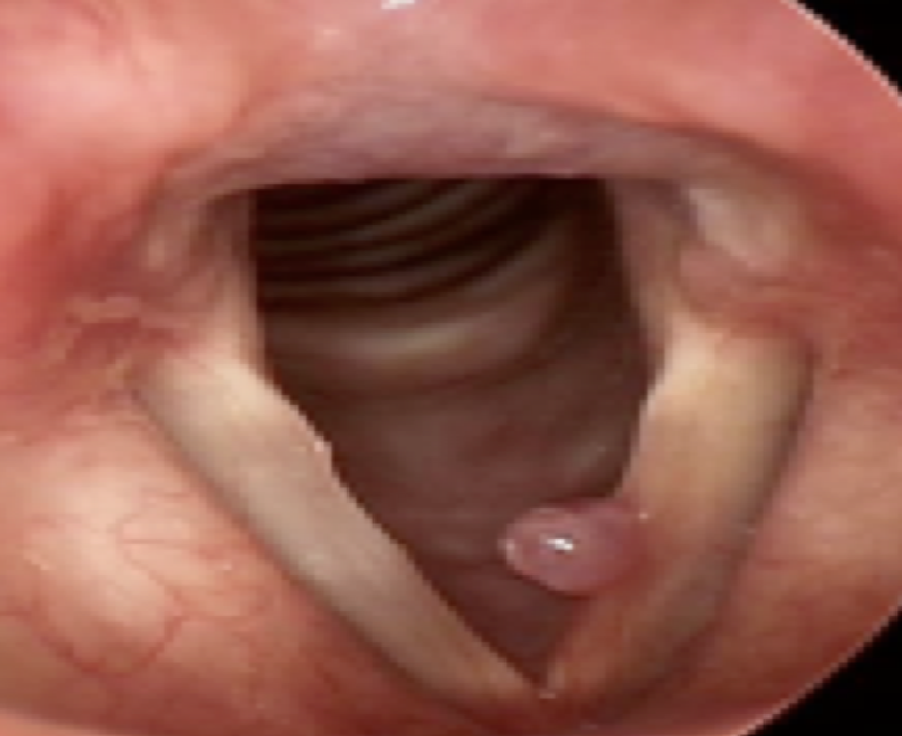 <p>blister filled with fluid or blood. can be directly on vocal fold usually at the midpoint (sessile), or attached by a separate piece of tissue (pedunculated)</p>