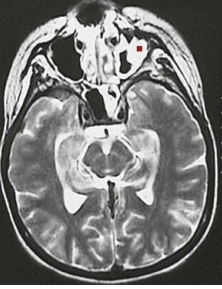 <p>8.2 Side A (PBD9: 389; BP9: 313)<br></p>
<p><br></p>
<p>Questions<br></p>
<p>A 15-year-old girl has a 2-day history of pain and swelling of the left side of her face. Labs show glucose 447 mg/dL, CO₂ 9 mmol/L, 4+ glucose and ketones in urine. MRI is shown.<br></p>
<p><br></p>
<p>1. What infection is she likely to have?<br></p>
<p>2. Where is this infection spreading?<br></p>
<p>3. What underlying diseases does she have?<br></p>