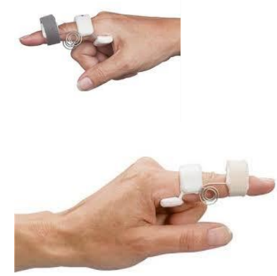 <p>What is the use of a dynamic capener splint (aka dynamic spring wire splint for PIP extension)?</p>