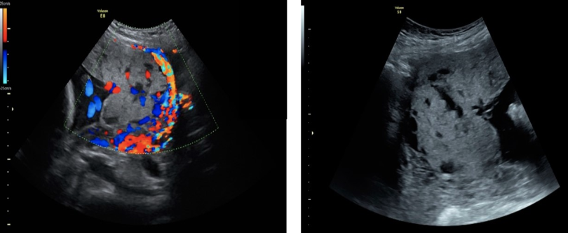 <p>which shows as <strong>hypoechoic</strong> areas within the placenta that display <strong>turbulent flow</strong> on color doppler</p><p>.</p><p>a) infarction</p><p>b) placenta accreta</p><p>c) fibrin deposition</p><p>d) venous lake</p>