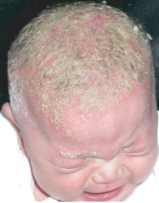 <ul><li><p><strong>Inflammatory dermatitis that occurs on the skin or scalp.</strong></p><ul><li><p>In infants, it most often occurs on the scalp, and it's called <em>Cradle Cap.</em></p></li><li><p>This usually resolves over weeks or months.</p></li><li><p>In adolescents, it typically develops on the scalp, eyebrows, eyelashes, behind the ears, and between the shoulder blades.</p></li></ul></li><li><p><strong>Nursing Care:</strong></p><ul><li><p><strong>Medications</strong>: Anti-dandruff shampoos containing selenium sulfate, ketoconazole, and corticosteroids.</p></li></ul></li></ul><p></p>