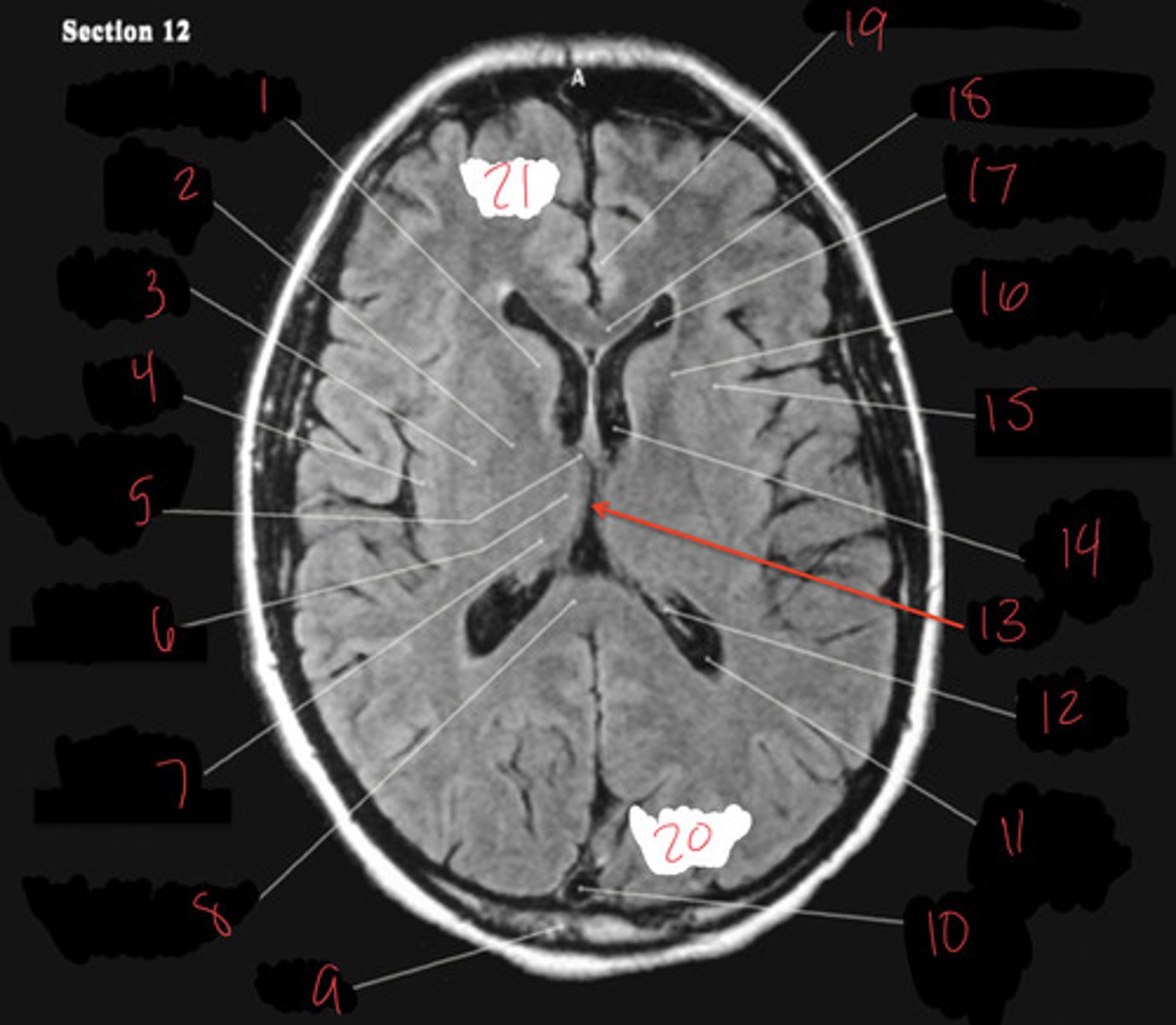 <p>connects lateral ventricles to third ventricle</p>