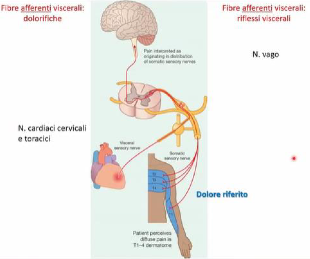 <p>Afferenti parasimpatiche → decorrono con il nervo vago, trasmettono informazioni sensoriali e sono dirette al tronco encefalico</p><p>Afferenti simpatiche → decorrono con i nervi cardiaci cervicale e toracici, trasmettono stimoli dolorifici e sono dirette al midollo spinale</p><p>Perché il dolore toracico da infarto è irradiato ad altre zone del corpo come il braccio sinistro?</p><ul><li><p>Nel Midollo Spinale a livello T1-T4 entrano sia:</p><ul><li><p>Fibre afferenti del cuore </p></li><li><p>Fibre afferenti somatiche dai dermatomeri T1-T4</p></li></ul></li><li><p>Questi dermatomeri sono strisce cutanee della parte anteriore del torace, ma siccome che T1 partecipa alla formazione del plesso brachiale, è coinvolto anche l’arto superiore nella sua parte mediale </p></li></ul><p></p>