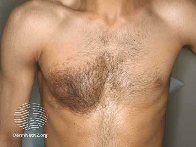 <ul><li><p>What is it?</p></li><li><p>More in males or females?</p></li><li><p>Associateds?</p></li><li><p>Is it malignant?</p></li><li><p>Tx?</p></li></ul>
