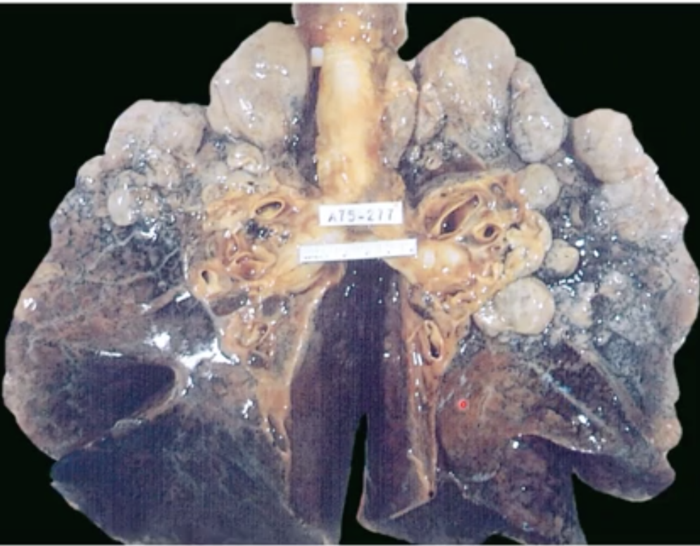 The dar smooth part is normal but the white parts are expanded alveoli 

Emphesyma is an example of obstructive lung disease 