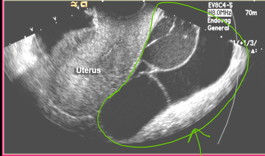 <p>Peritoneal inclusion cysts are ______ cystic _____ masses</p>