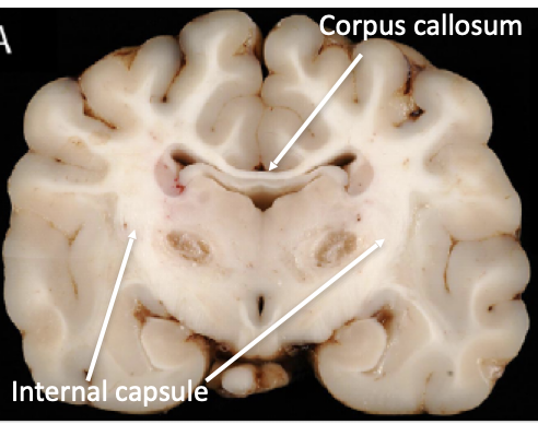 <p></p><ul><li><p><strong>Corpus callosum</strong></p><ul><li><p>Connect left and right hemispheres found only in placental mammals (not marsupials/monotremes or reptiles, birds, etc)</p></li></ul></li><li><p><strong>Internal capsule</strong></p><ul><li><p>Connect cerebral hemispheres with brain stem</p></li></ul></li><li><p><strong>Peduncles of the cerebellum</strong></p><ul><li><p>Connects cerebellum with pons and medulla oblongata </p></li></ul></li><li><p><strong>Corona radiata</strong></p><ul><li><p>Can associate with the internal capsule to relay information to and from cerebrum via thalamus and brainstem </p></li><li><p>Is essentially the fan-like branches of white matter that connects the cerebral cortex to the internal capsule </p></li></ul></li></ul><p></p>