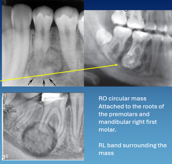 <ul><li><p>concentric </p></li><li><p>RL rim </p></li><li><p>attached to the root w resorption → tooth vital but can be associated w pain </p></li><li><p>PDL not visible </p></li></ul><p></p>