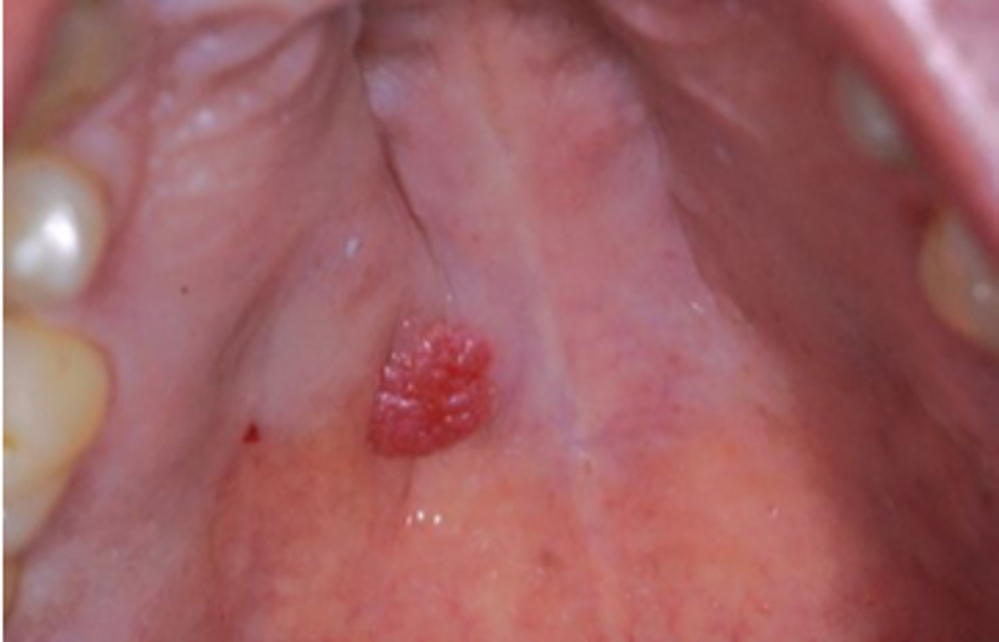 <p>Benign Salivary Gland Tumors:</p><p>Exophytic and Papillary, Minor salivary glands</p><p>Inverted type</p><p>▫ lower lip and MD vestibule</p><p>▫ indentation</p>