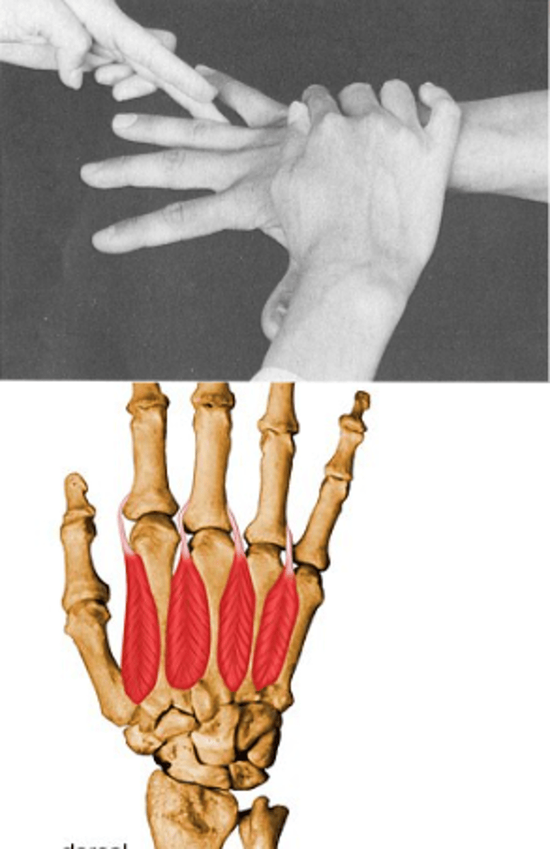 <p>Fő működés: abdukció (II, IV ujjak, III-as stabilizálás)</p><p>KH: könyök enyhe flexioban, alkar pronatio, csukló az alkar folytatásában. I, V. ujj abdukcióba (külön izmuk van), II-IV adductioban</p><p>Rögzítem a metacarpust</p><p>II-t, IV-t távolítsa a III.-tól, III.-at mindkét irányba mozgatgassa kicsit</p><p>Ellenállás: proximalis phalanxra kívülről. III.-nál mindkét irányból</p>