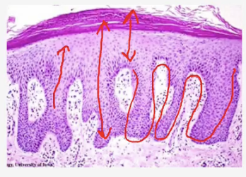 <p><strong><u>hyperkeratosis </u></strong>(<span>Thickened stratum corneum (outer keratin layer</span>) and<u> </u><strong><u>acanthosis</u> with </strong>thickened epidermis (increased squamous cell layers) & r<span>ounded epidermal ridges.</span></p>