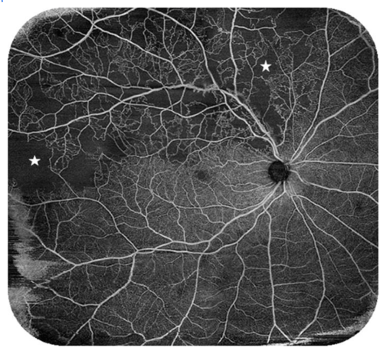 <p>dark areas = non-perfusion (capillary dropout)</p>