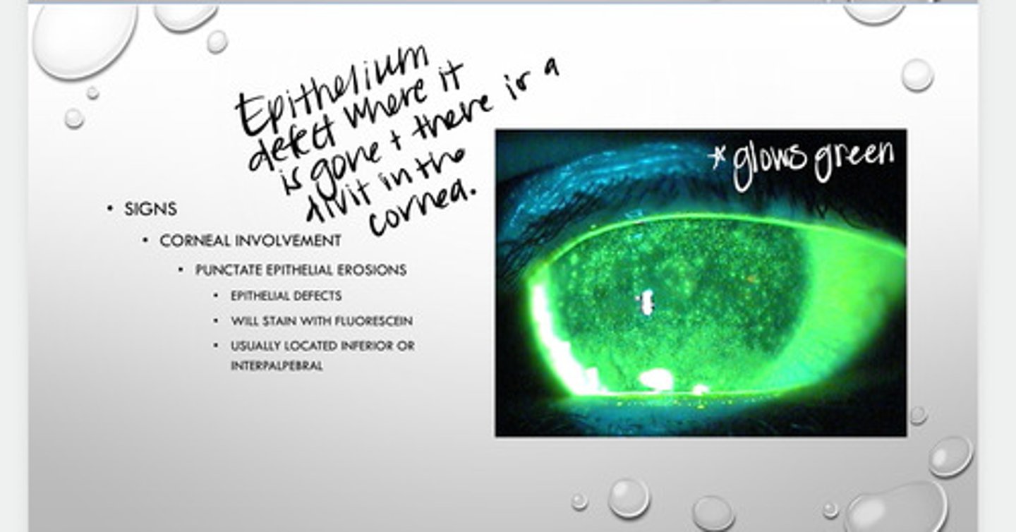 <p>What are punctate epithelial erosions (PEEs)?</p>
