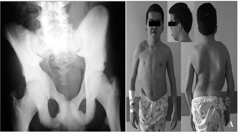 <p>= marmerbeenziekte = marble bone disease</p><ul><li><p>zeldzame congenitale ziekte die excessieve botvorming tot gevolg heeft met overgroei &amp; verdikking van het bot (wordt denser &amp; zwaarder)</p></li><li><p>mutaties in genen die verantwoordelijk zijn voor ondermeer goed functioneren van osteoclasten</p></li><li><p>skeletdeformaties (wervelkolom, schedelbeenderen), groeistoornissen, fracturen (niettegenstaande het bot dikker &amp; denser is, is het juist brozer van consistentie), vernauwing van beenmergruimten (verminderde bloedcelvorming met o.a. anemie &amp; verminderde witte bloedcellen, cave verminderde weerstand tegen infectie), blindheid, doofheid, faciale paralyse (tgv druk van bot op zenuwstructuren)</p></li></ul><p></p>