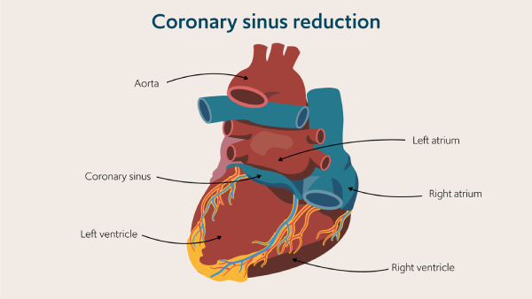 * short Wide channle 
* Posterior Coronary Groove (left → Right)
* Between LT atrium & LT Ventricle
* opening in RT atrium (left to IVC)
* Guarded by small valve 