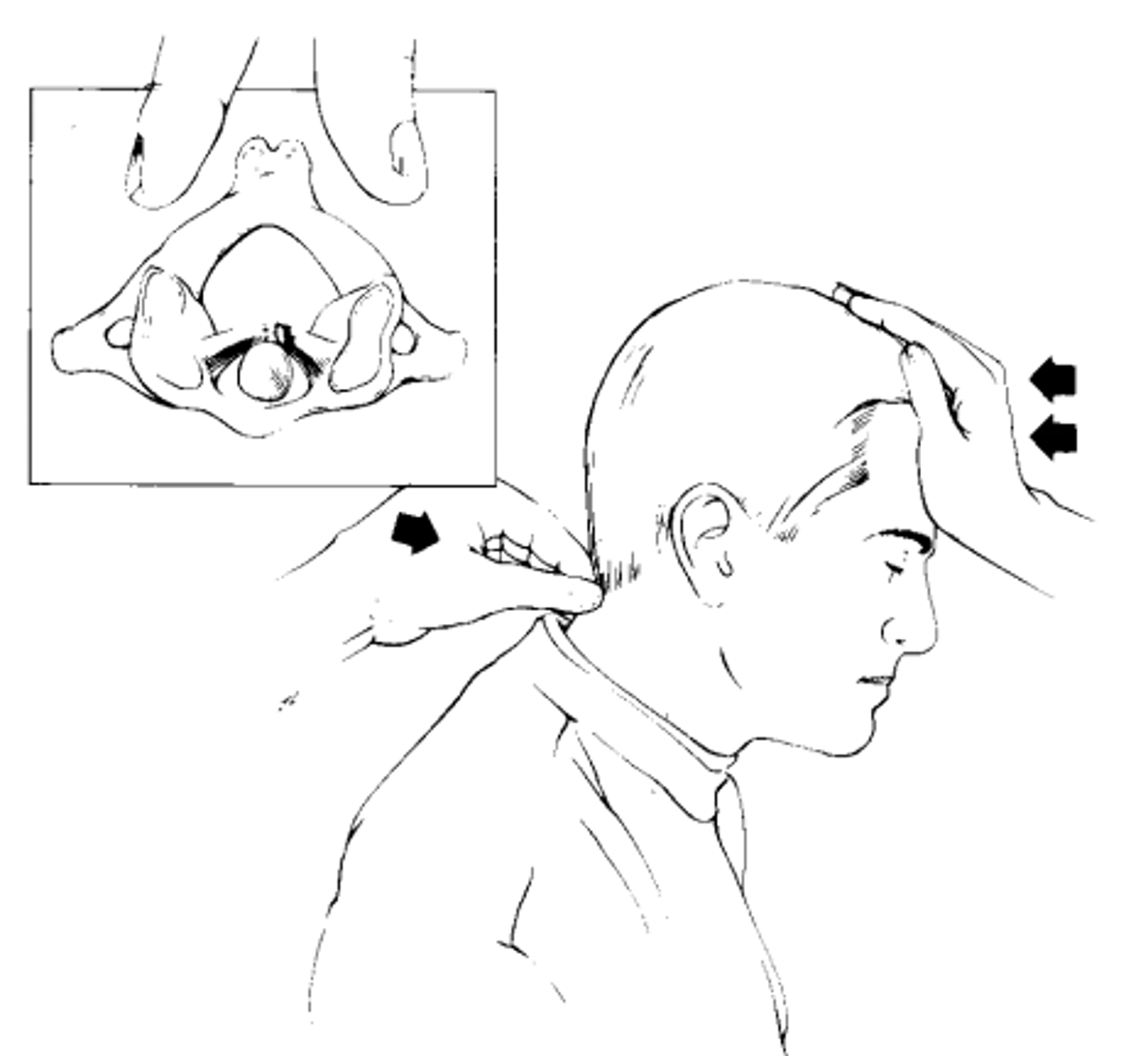 <p>*sagittal stability of AA</p><p>- pt seated, short neck flexion</p><p>- pt reports any sxs or clunking sensation</p><p>- if symptomatic, clinician stabilizes C2 posteriorly and applies posterior force to forehead</p><p>- (+) = reduction or resoution of sxs with posterior force</p>