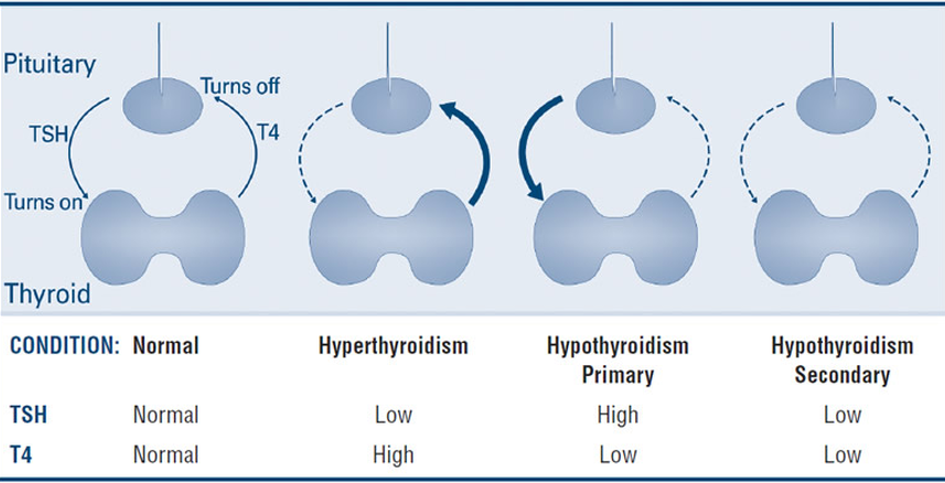 <p>Normal - TSH = Normal, T4 = Normal </p><p>Hyperthyroidism - TSH = Low, T4 = High </p><p>Hypothyroidism Primary - TSH = High, T4 = low </p><p>Hypothyroidism Secondary - TSH = Low, T4 = low </p>