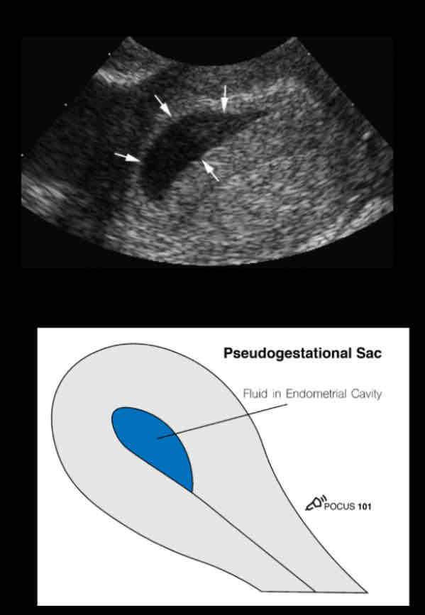 <p><span>• more irregularly shaped</span><br><span>• Pointy-edged than a round gestational</span><br><span>sac.</span><br><span>• Border surrounding the sac is not as</span><br><span>echogenic</span><br><span>• The fluid is not completely anechoic,</span><br><span>there are some echoes seen in the fluid.</span><br><span>• A pseudo-gestational sac will not have</span><br><span>the contents of a maturing gestational</span><br><span>sac such as the yolk sac and embryo.</span></p>