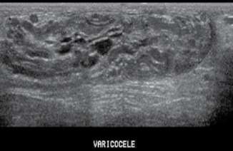 <p>sono appearance of varicocele</p>