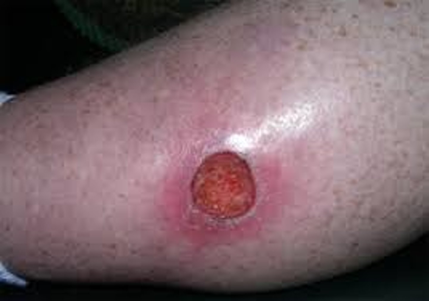 <p>are open areas of skin that result from loss of part or all of the epidermis. can be traumatic or can occur with various inflammatory or infectious skin diseases</p>