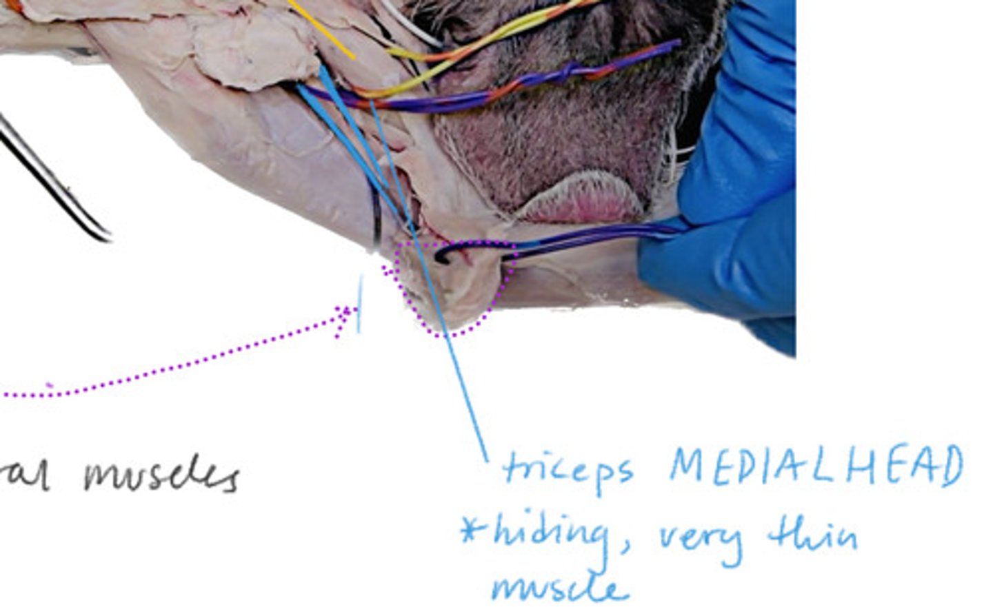 <p>In the middle between the long head, lateral head, and brachialis.</p>