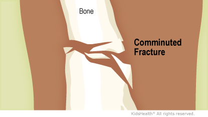 <ul><li><p>a fracture in which the bone is broken into more than two fragments </p></li></ul><p></p>